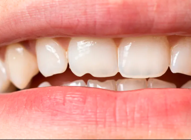How a Broken Tooth Can Affect Your Smile and How To Fix It