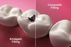 The Differences Between Amalgam and Composite Fillings