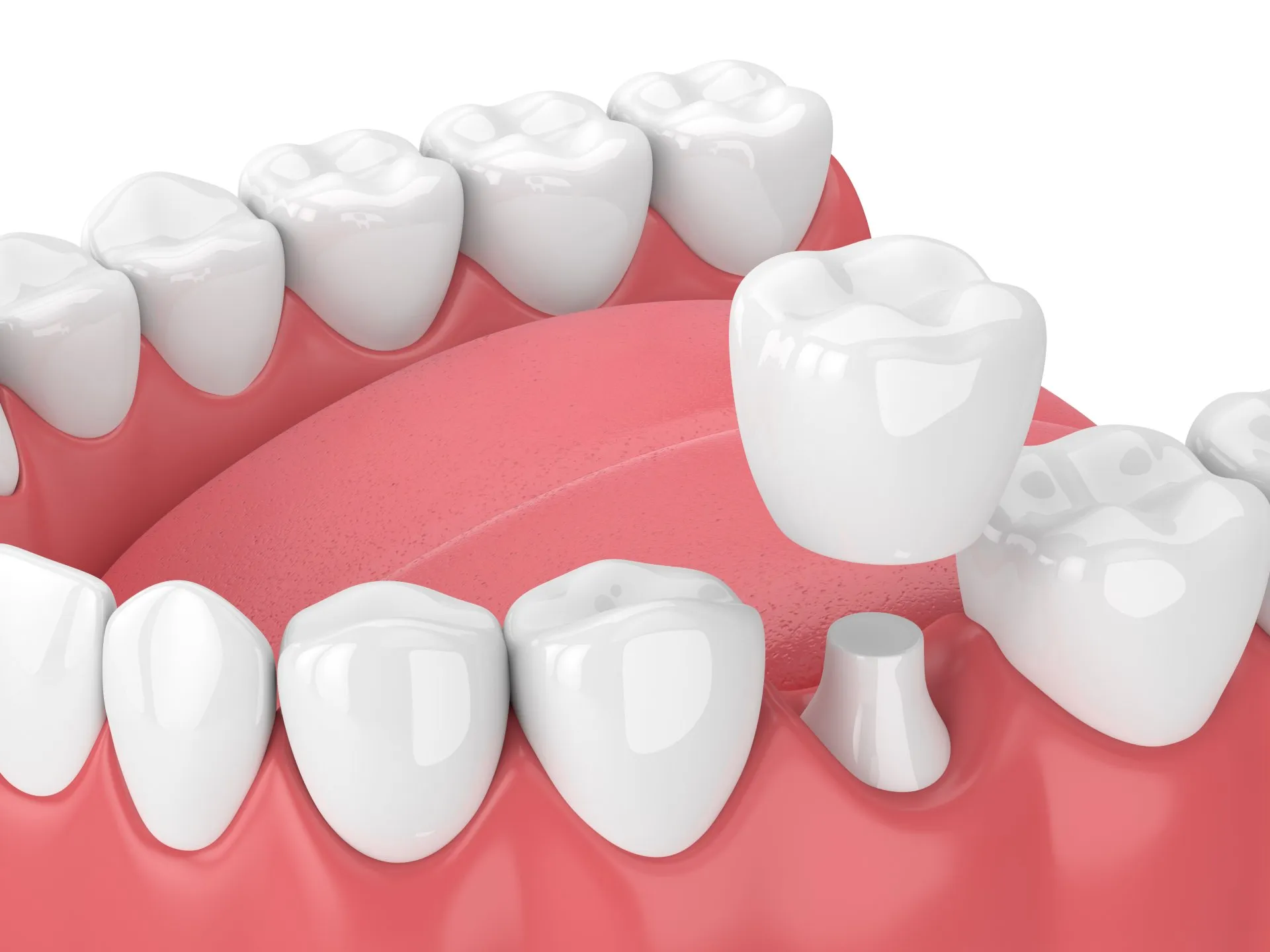 Understanding the Different Types of Crowns for Dental Restorations
